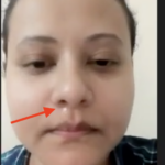Recovery from CSF Leak Case from Guwahati